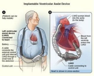 Ventricular Assist Device (VAD) • LITFL • CCC Equipment