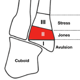 Eponymous Fractures LITFL Orthopaedic Eponyms Eponymous Fractures LITFL Orthopaedic Eponyms