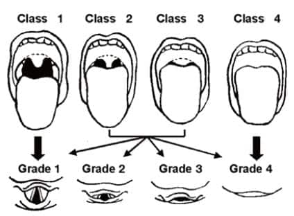 Mallampati Score - LITFL - Medical Eponym Library | IWOFR