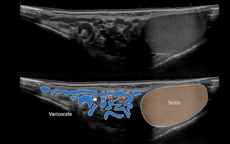 Ultrassonografia De Varicocele
