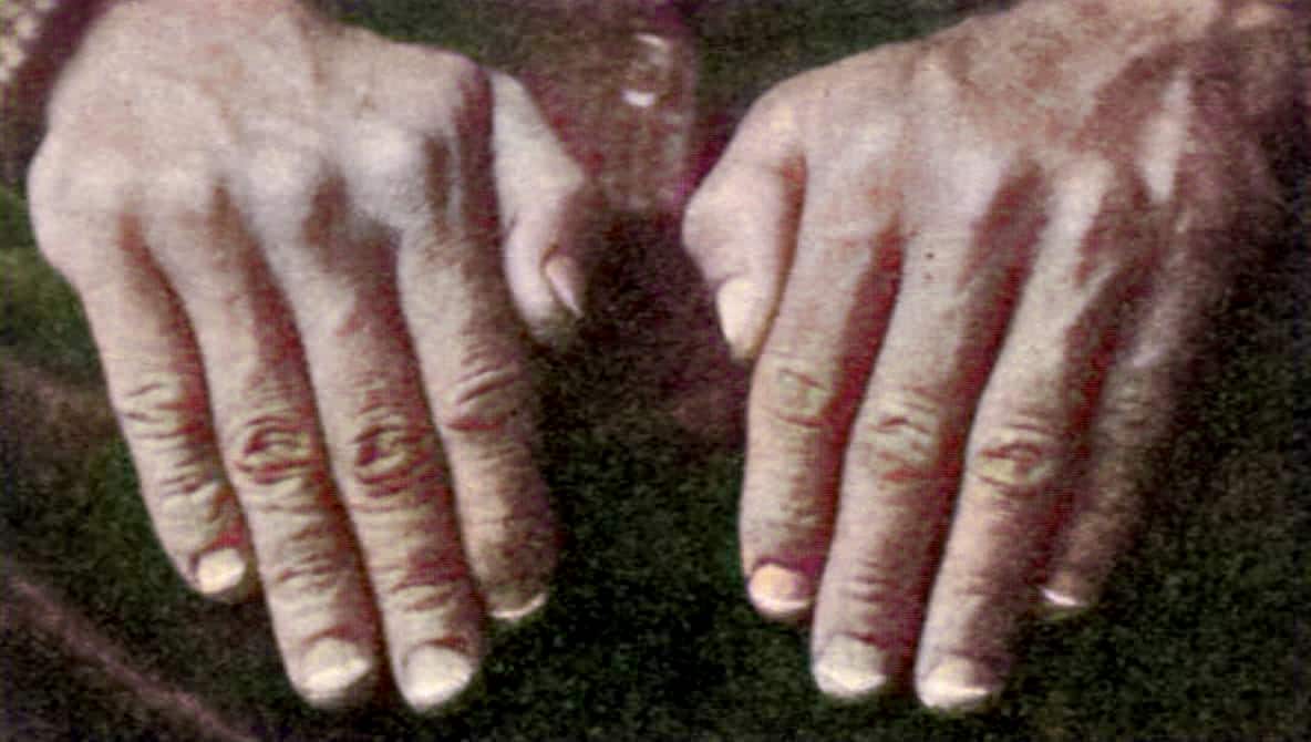 arsenic poisoning fingernail signs