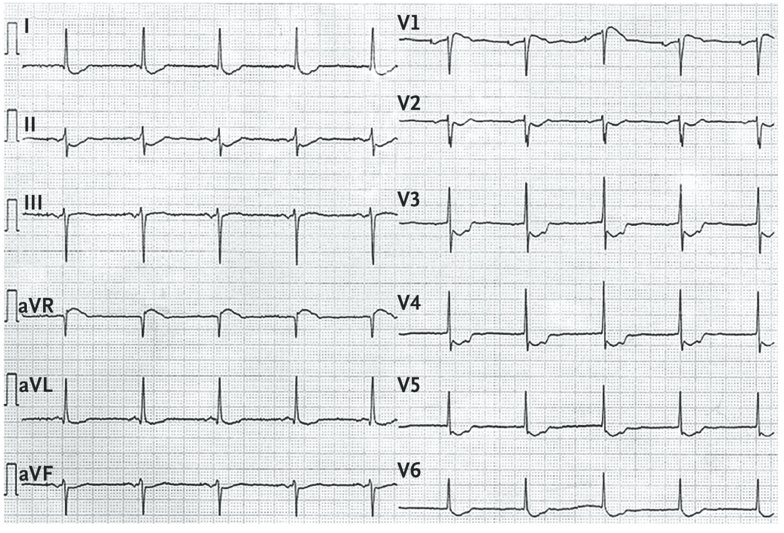 Bundgaard Syndrome LITFL ECG Library bundgaard-syndrome-litfl-ecg-library