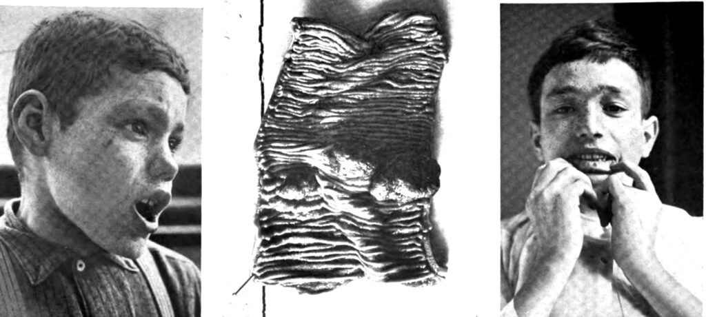 Combined familial polyposis with peculiar skin pigmentations
