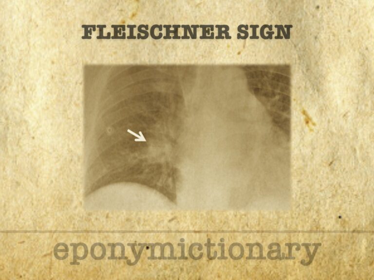 Fleischner sign 680