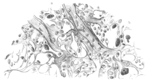 Greenfield drawing Reed-Sternberg cells 1878