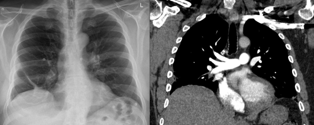 Hampton hum CXR CT