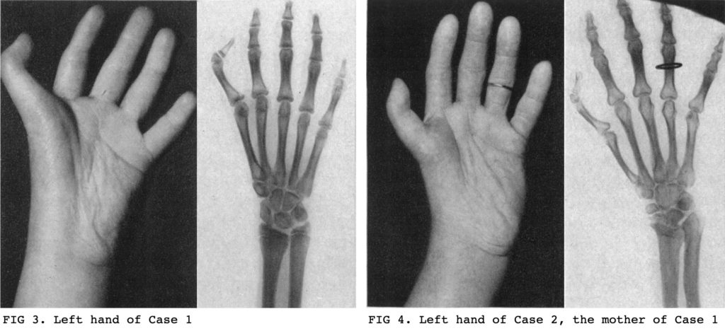 Holt-Oram syndrome fig 3 and Fig 4 1960