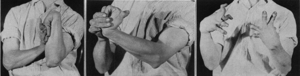 Hypermobility of joints and assessment 1927
