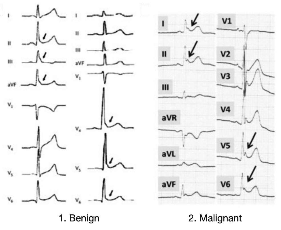 repolarization ecg