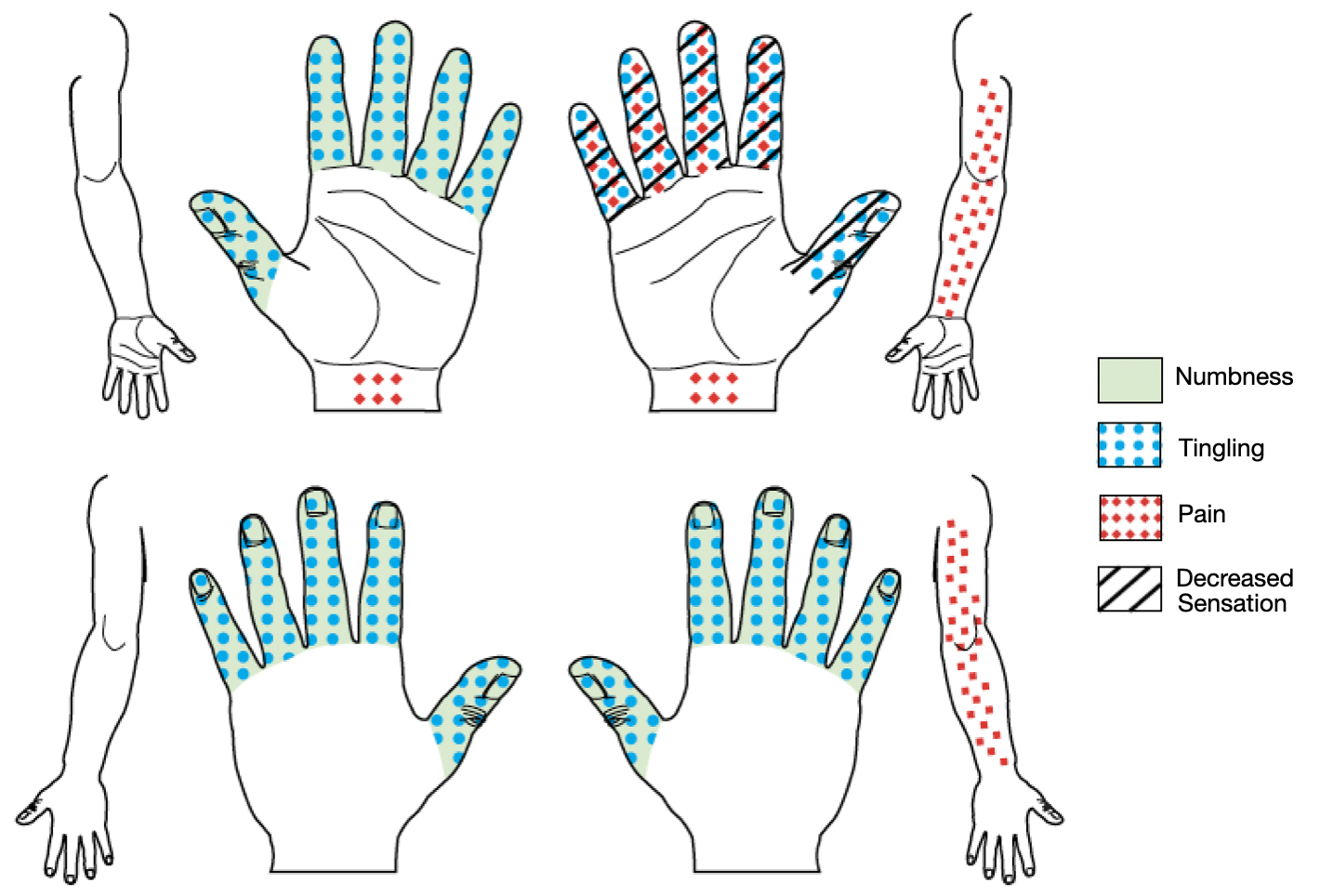 Katz–Stirrat hand diagram