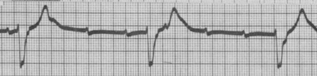 Lenegre Atypical Bundle Branch Block 2