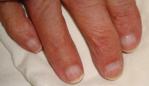 Beau's Lines On Nails: Causes, Symptoms, and Solutions