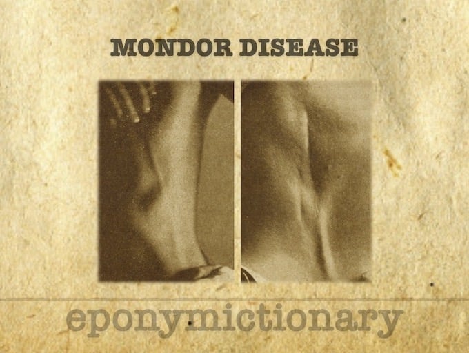 Mondor disease 1939 680