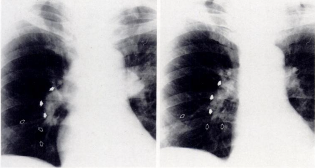 Palla sign 1983 Figure 5