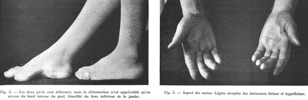 Roussy G, Lévy GA. La dystasie aréflexique héréditaire 1932