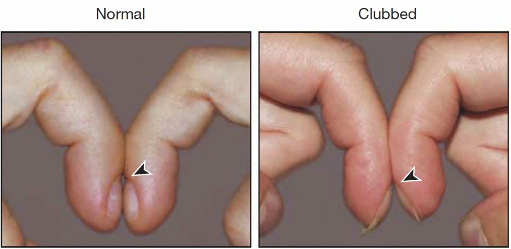 Schamroth sign Pallares-Sanmartin et al 2010