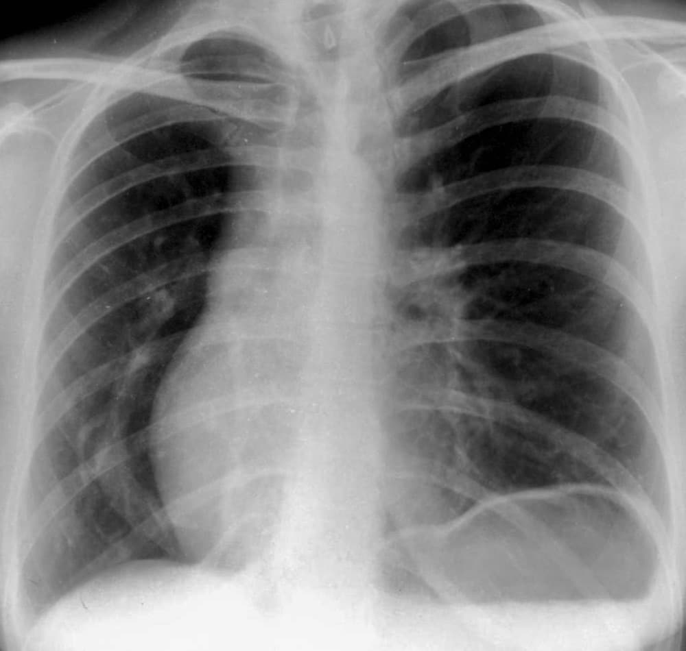 Scimitar syndrome CXR vein with scimitar 001