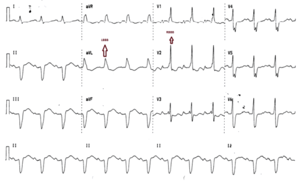 Standard MBBB. RBBB pattern in precordial leads V1-3