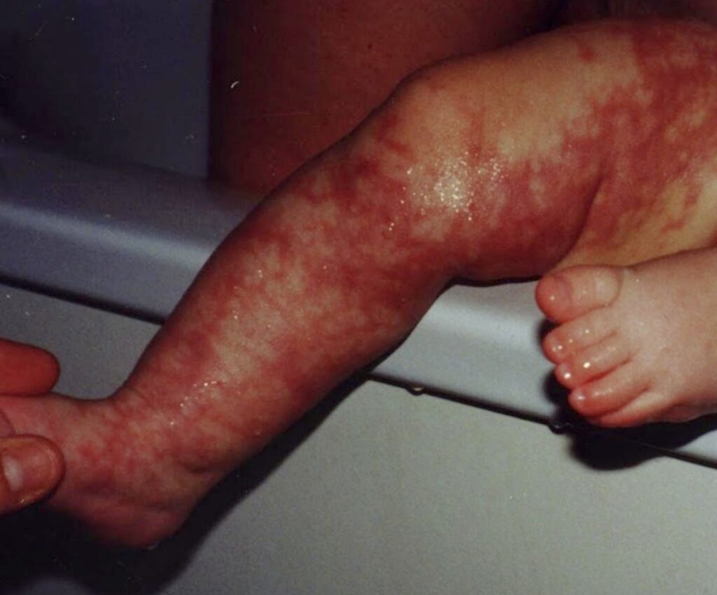 Van Lohuizen syndrome CMTC skin warming