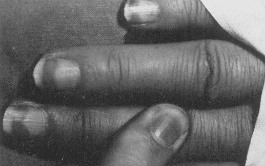 William Bennett Bean 1963 half and half nails