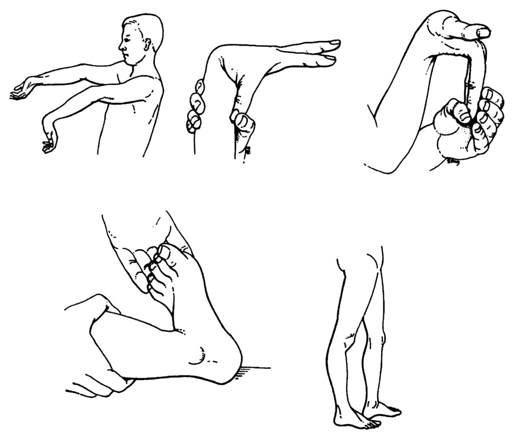 Wynne-Davies Ligamentous Laxity (1970)