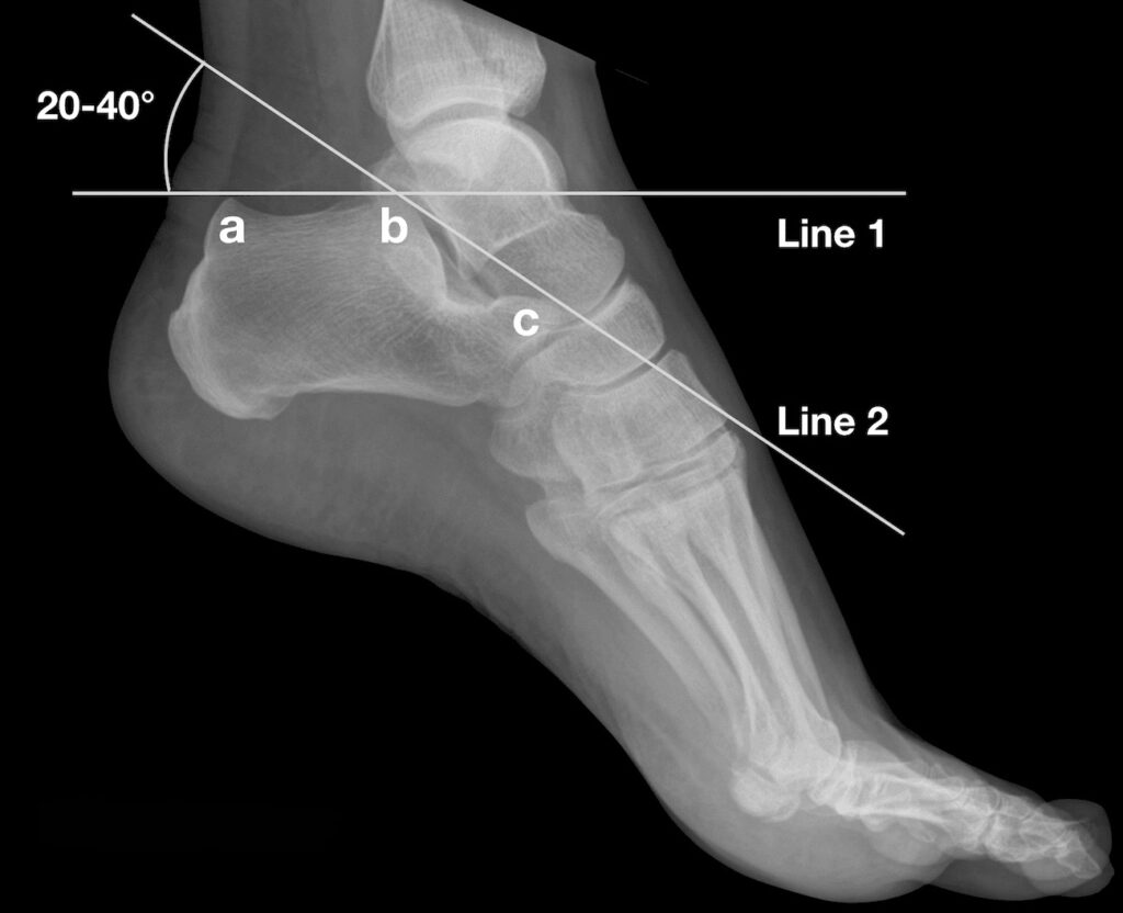Bohler-Angle-1931-calcaneal-fracture-tuber-angle-2