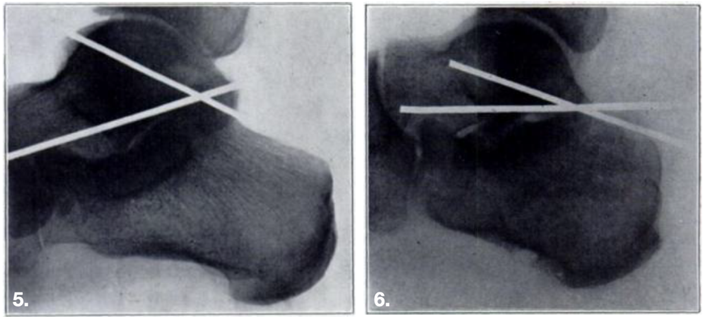 Böhler L. Diagnosis, pathology and treatment of fractures of the os calcis Fig 5 and 6