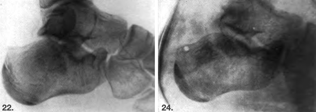 Böhler’s Gelenk-Tuberwinkel 1929