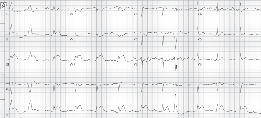 Case 3a Kounis syndrome 2015 Memon