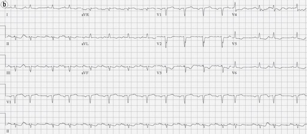 Case 3b Kounis syndrome 2015 Memon