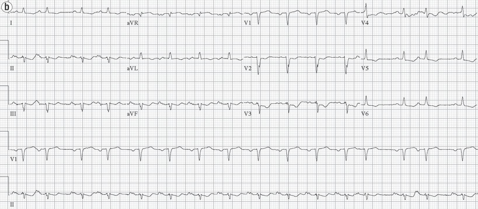 Allergy Induced Myocardial Infarction - Kounis Syndrome / Coronary  Hypersensitivity Disorder / Vasospastic Angina