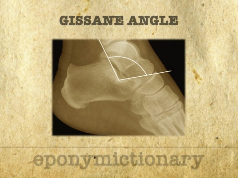 Gissane angle 680