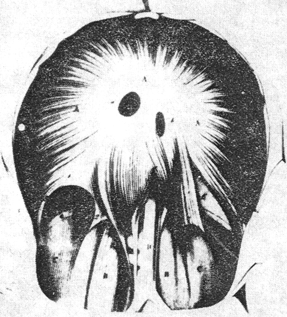 Inferior view of diaphragm showing a triangular posterolateral membranous area (Bochdalek foramen) 1848