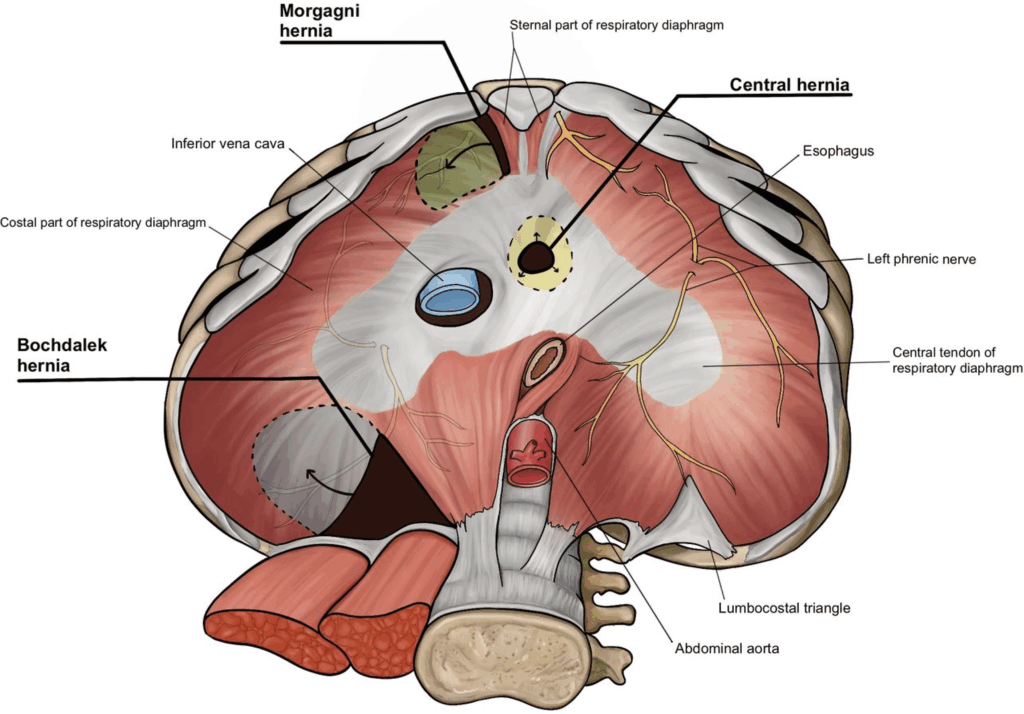 Morgagni and Bochdalek diaphragmatic hernia