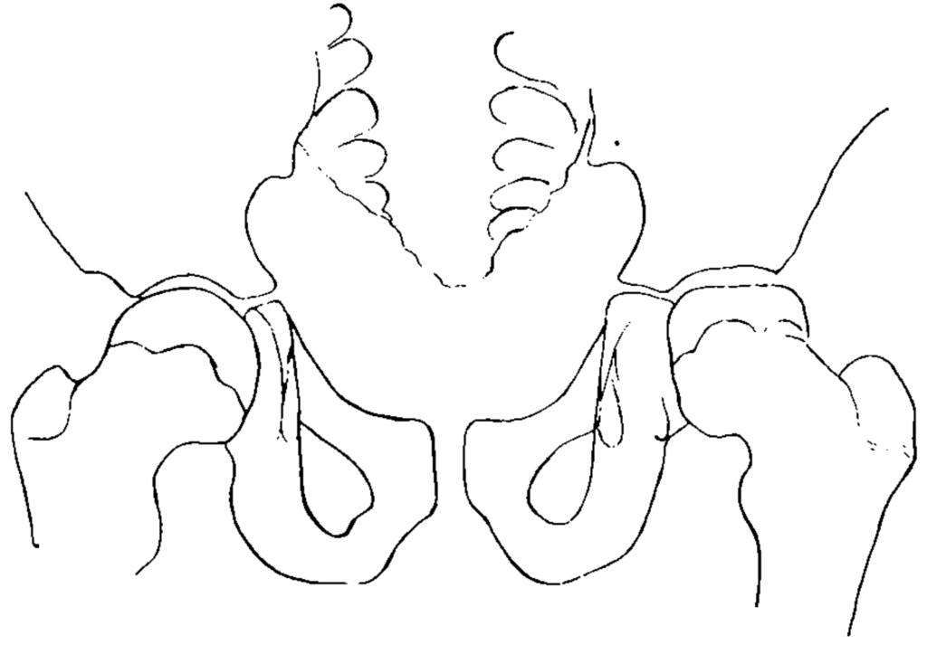 Perthes 1909 11 year old boy Fig 3