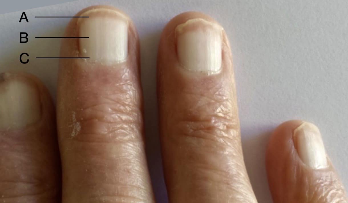 Terry S Nails Litfl Medical Eponym Library