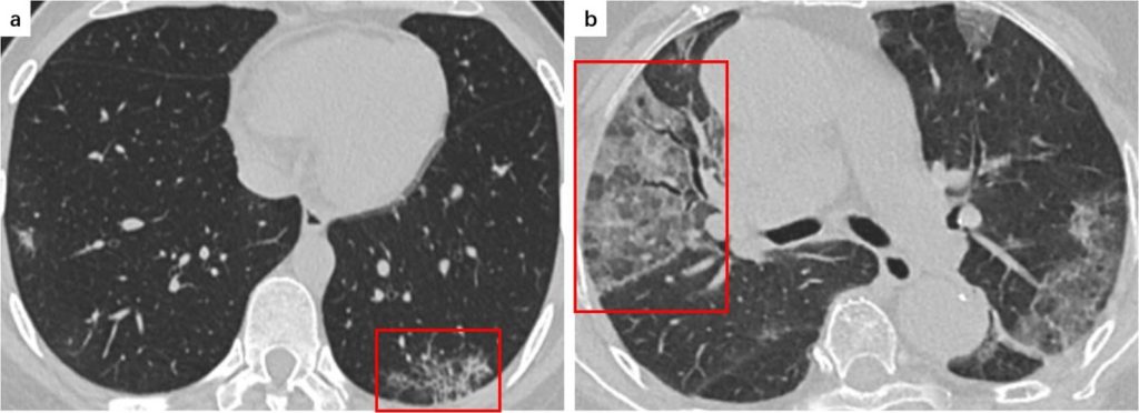 Shows a reticular pattern in the left lower lobe