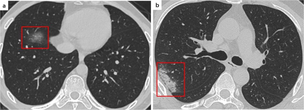 Shows isolated ground glass opacity in right lower lobe