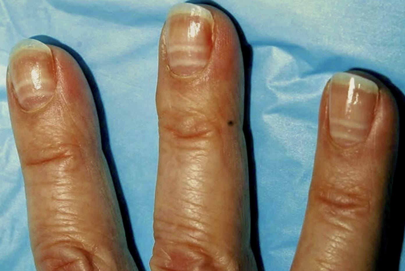 Aging changes in nails: MedlinePlus Medical Encyclopedia Image