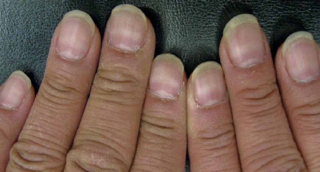 If you see any of these nail anomalies, get medical help right once.