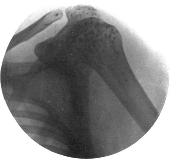 Radiographie de l'épaule droite vue par sa face postérieure 1916