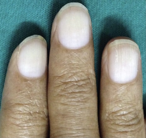 Nail matrix psoriatic manifestations visible on the nail plate 12 |  Download Scientific Diagram