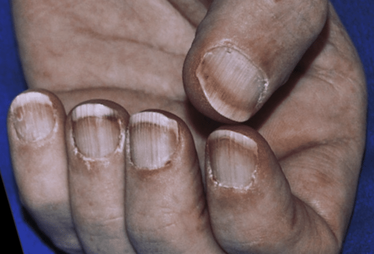 Nail dyschromias - Indian Journal of Dermatology, Venereology and Leprology