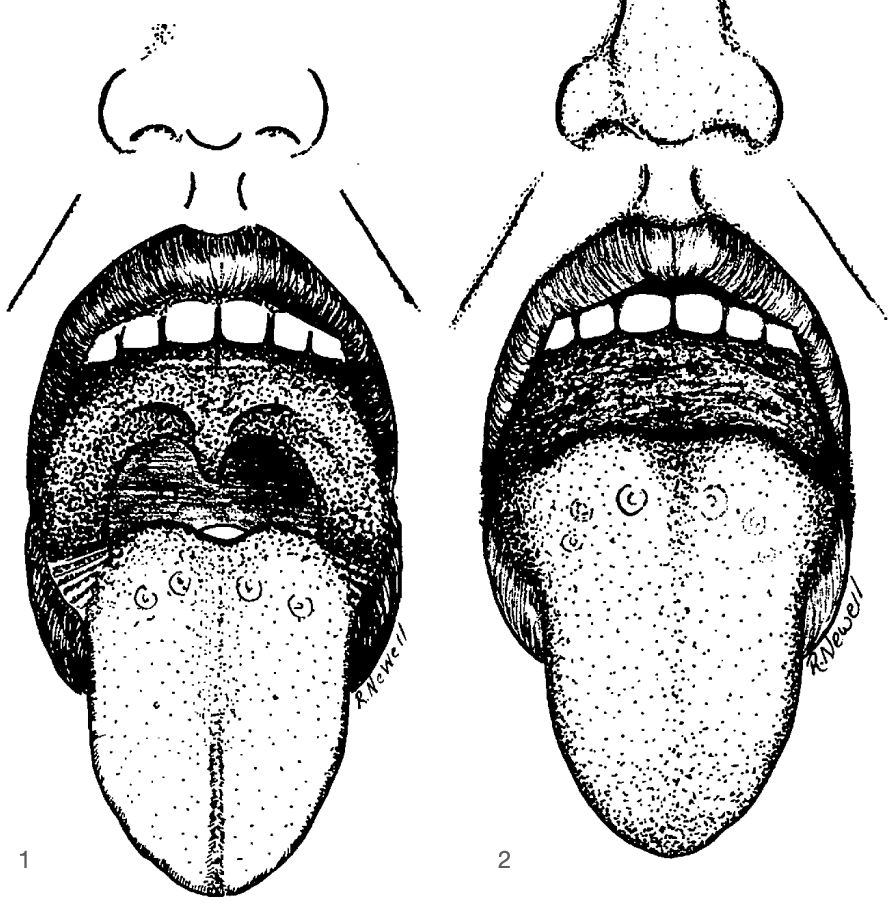 faucial pillars