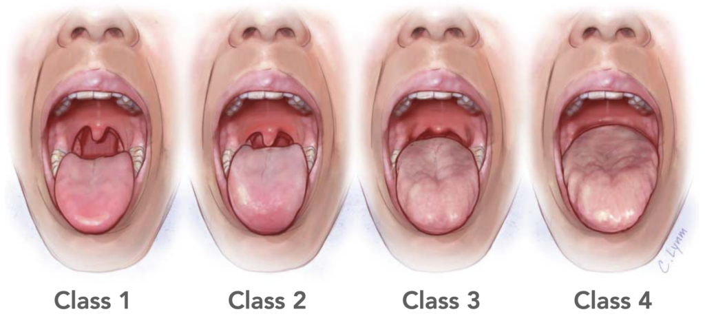 Mallampati classification JAMA 2013