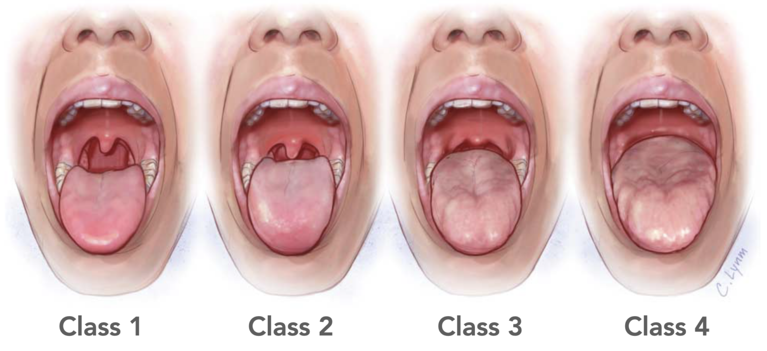 Mallampati score litfl medical eponym library