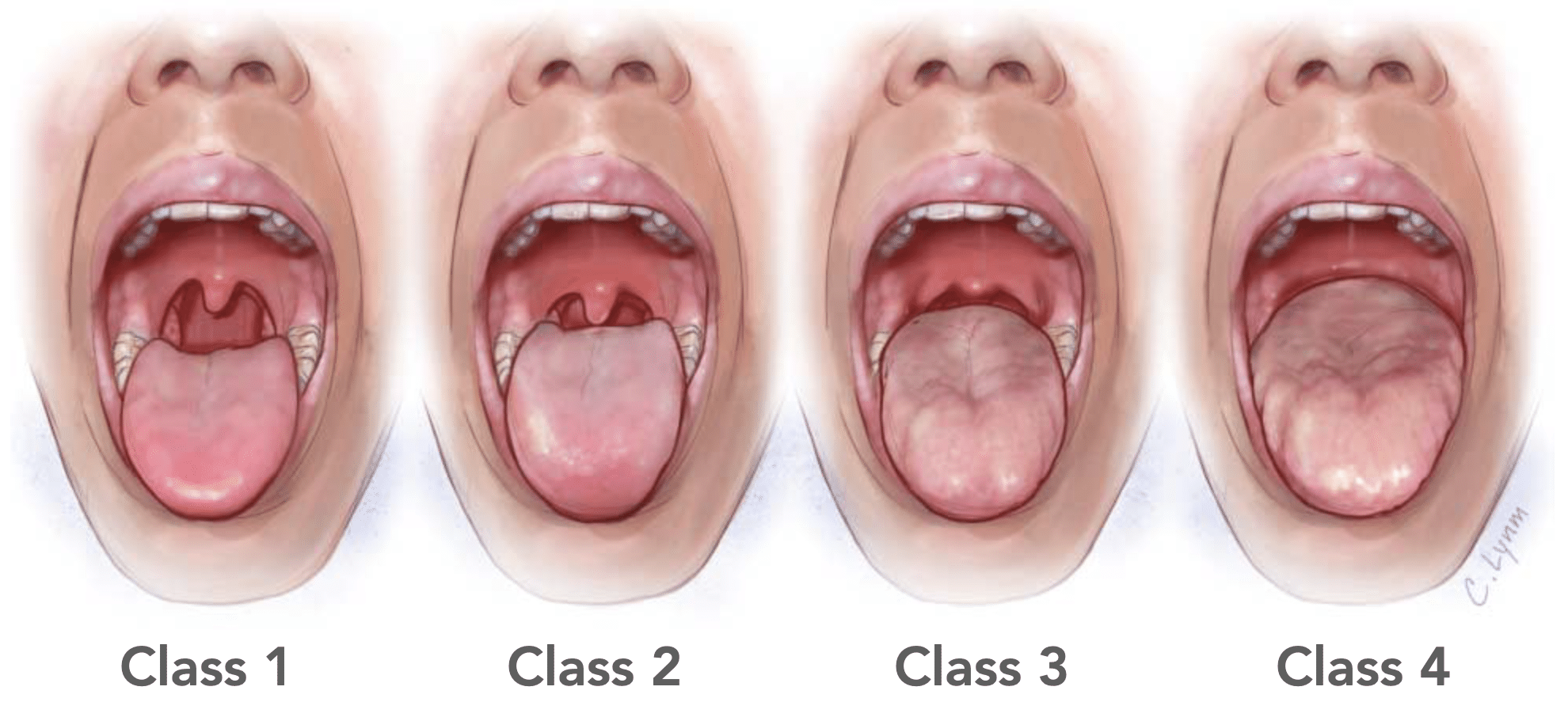 faucial pillars