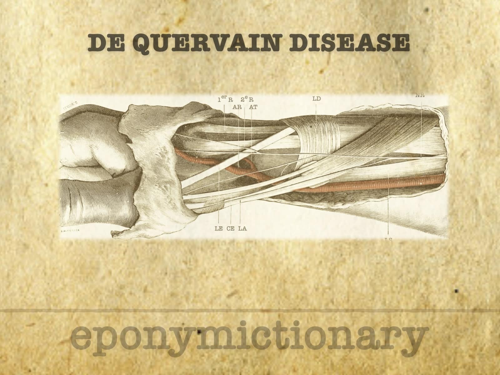 De Quervain Disease