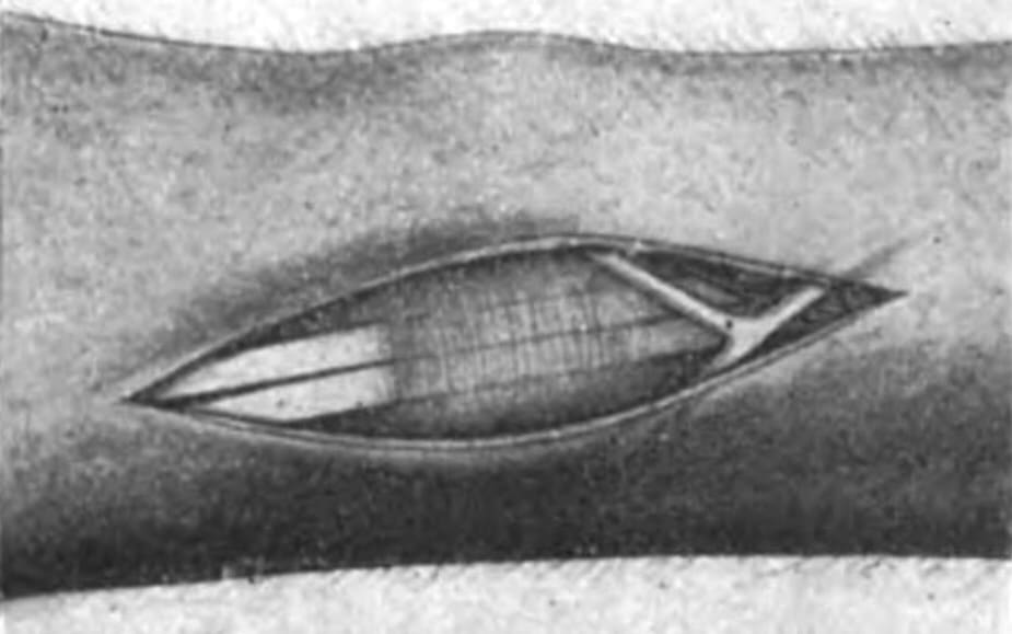 De Quervain disease operation (1912)