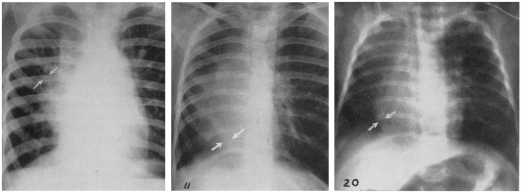 Halasz Scimitar syndrome 1956